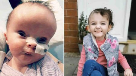 Un bébé né avec une maladie cérébrale qui le faisait ressembler à un extraterrestre a maintenant 5 ans et s’épanouit