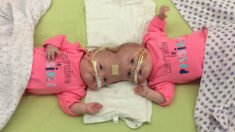 Des jumelles conjointes, qui ont survécu à une opération de séparation, reçoivent leurs diplômes de la maternelle: photos