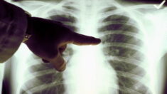 Cancer du poumon : un nouveau vaccin augmente l’espérance de vie des patients atteints de la maladie