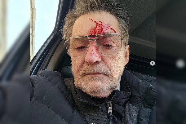 L'antiquaire Michel Bimier a posté une photo de lui le visage blessé sur Instagram. (compte Instagram michelbimier)