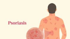Le guide essentiel du psoriasis : symptômes, causes, traitements et approches naturelles