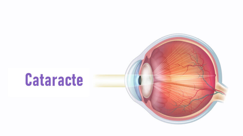 Les cataractes sont la cause la plus fréquente de cécité. (Illustrations d'Epoch Times, Shutterstock)