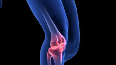 Un ligament croisé du genou peut guérir sans chirurgie