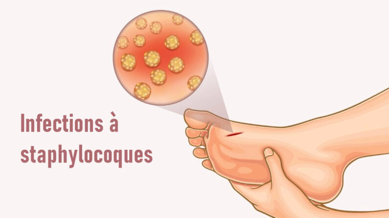 Il existe plus de 30 types de bactéries staphylococciques, dont certaines sont résistantes aux antibiotiques. (Illustrations d'Epoch Times, Shutterstock)