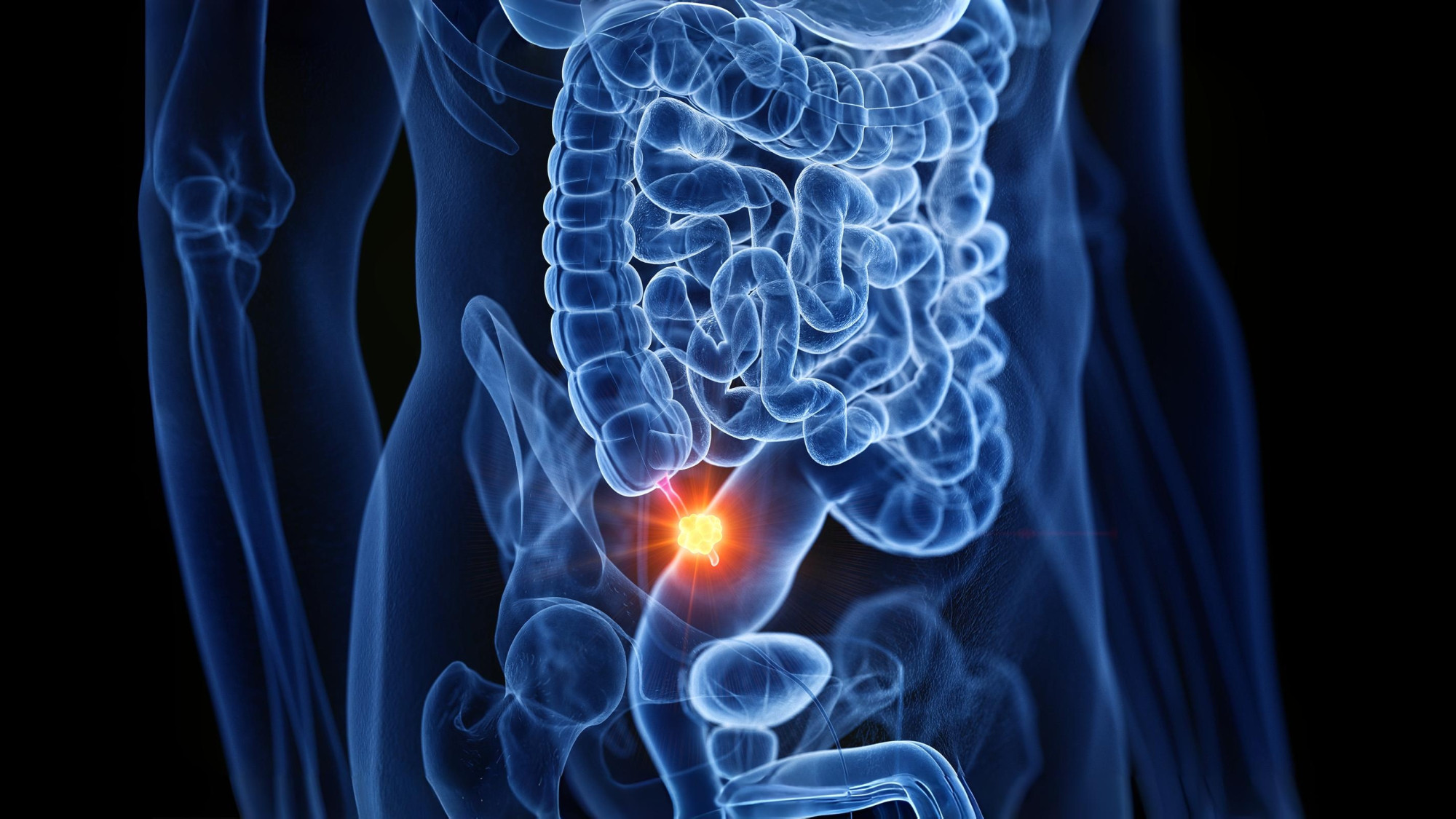 Les taux de cancer de l'appendice quadruplent chez les milléniaux plus âgés, les signes passant souvent inaperçus